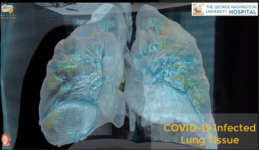 VR technology reveals lung damage in coronavirus patient